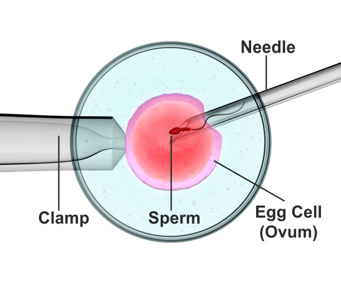 ICSI Treatment in Hyderabad